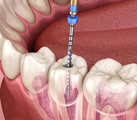 Conservative Dentistry & Endodontics