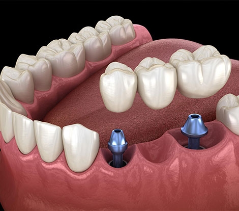 Prosthodontics and Crown and Bridge